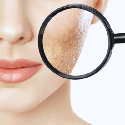 dermal fillers for acne scars