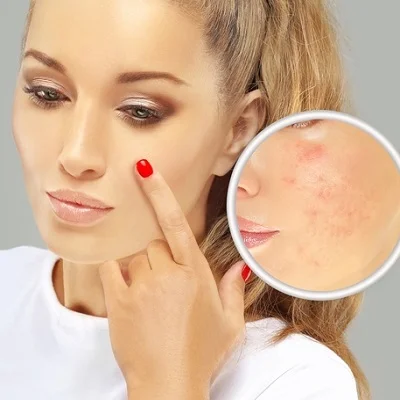 surgical options for acne scars