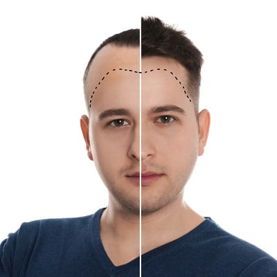 hair transplantation