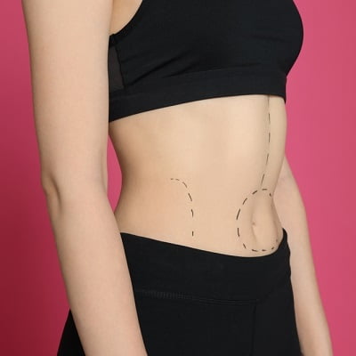 myths about bariatric surgery