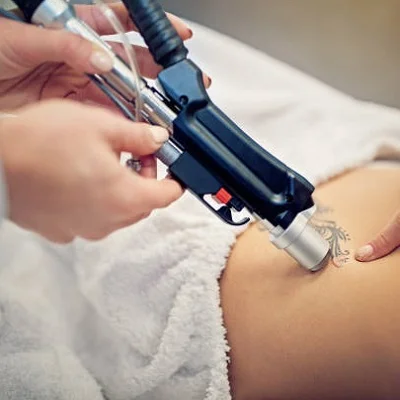 How much does laser tattoo removal cost in Islamabad?