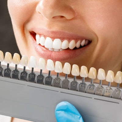types of dental veneers