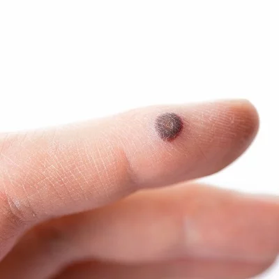 warts removal in islamabad