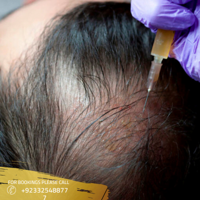 What are the treatment options for acne scarring