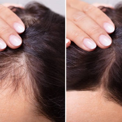 wet hair lead to hair loss