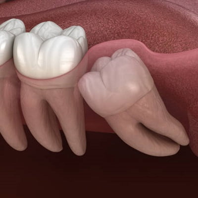 Is it possible to do all wisdom tooth extraction at once