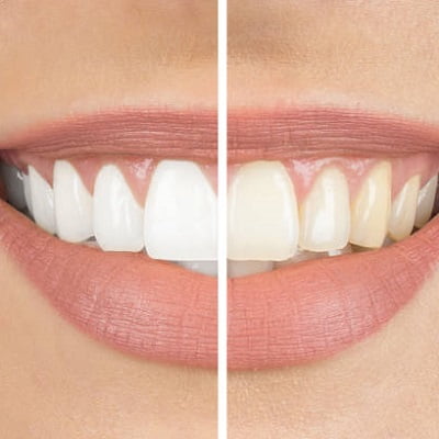 Is teeth whitening for sensitive ones good?
