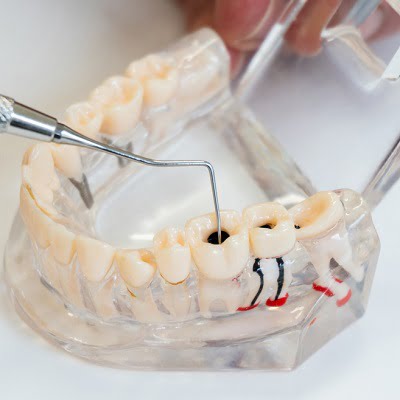 What to eat after root canal treatment
