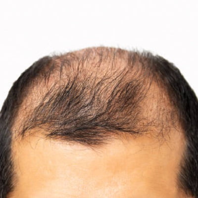 FUE crown hair transplant