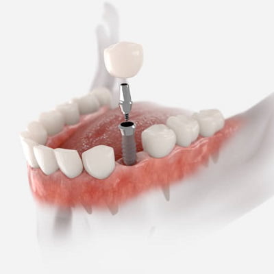 How many dental implants do I require
