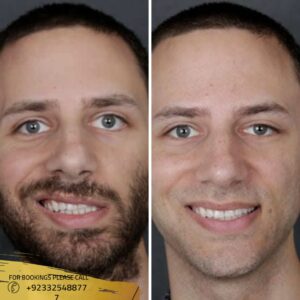 Nerve reconstructive Surgery in Islamabad