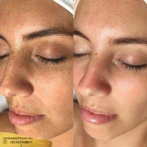 Oxygen Facial Treatment before and after