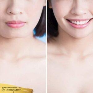 result of chin augmentation