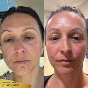 Oxygen Facial Treatment cost in Islamabad