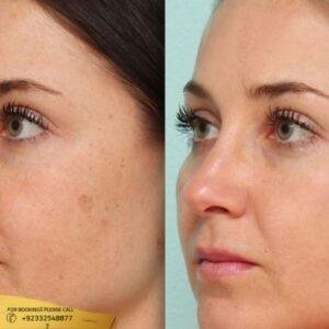 Results of Oxygen Facial Treatment