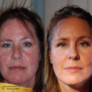 Rosacea treatment before and after