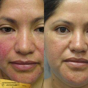 Rosacea treatment cost in Islamabad