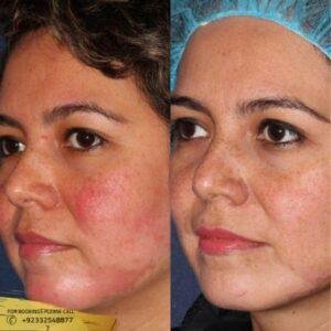 Results of Rosacea treatment