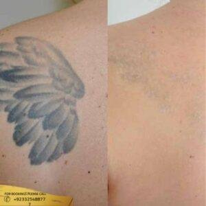 Laser Tattoo Removal cost in Islamabad