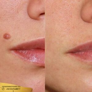 Mole Removal before and after