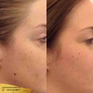 Mole Removal cost in Islamabad