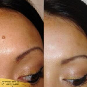 Results of Mole Removal 