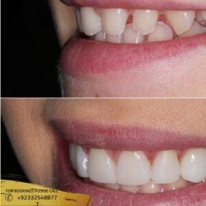 Composite Veneers cost in Islamabad