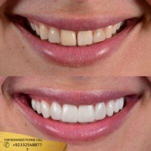 Composite Veneers before and after