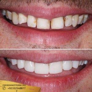 Results of Composite Veneers