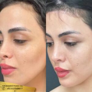 Cheek Implants before and after