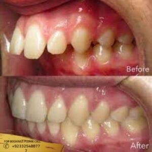 Protruding Teeth treatment cost in Islamabad
