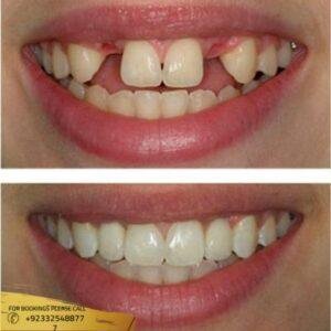Protruding Teeth treatment before and after