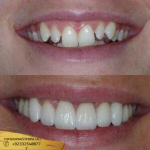 Results of Protruding Teeth treatment
