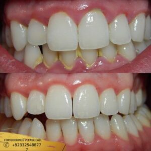 teeth scaling and polishing before and after