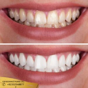 teeth scaling and polishing cost in Islamabad