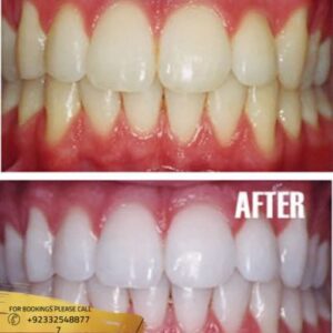 Results of teeth scaling and polishing