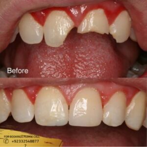 Teeth Fracture Treatment before and after