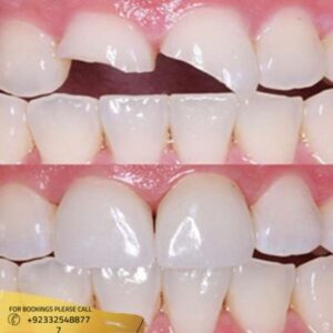 Teeth Fracture Treatment cost in Islamabad