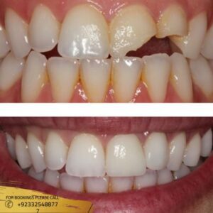 Results of Teeth Fracture Treatment
