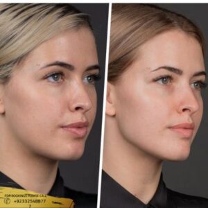 Results of Cheek Implants