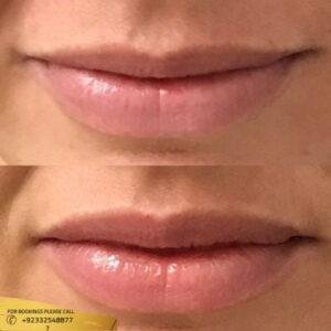 Results of Botox Lip Flip