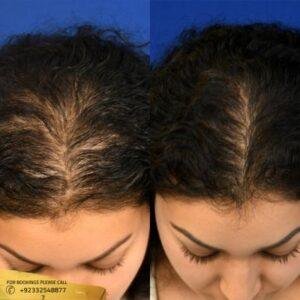 filler injections with PRP before and after