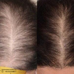 filler injections with PRP cost in Islamabad