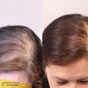 Results of Hair Fillers Treatment