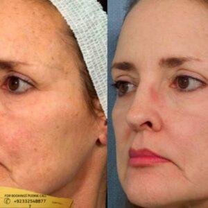 Results of Skin Rejuvenation