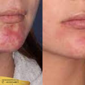 Birthmark Removal before and after