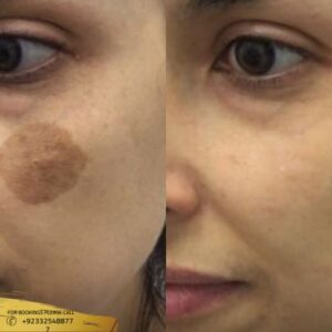 Birthmark Removal cost of Islamabad