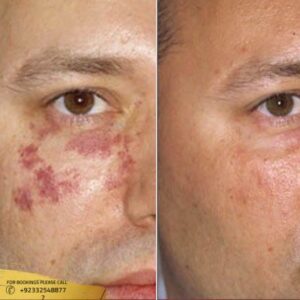 Results of Birthmark Removal