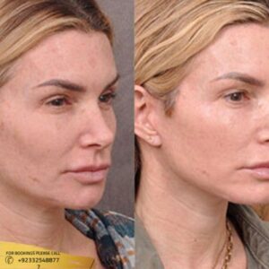 Facial Treatment cost in Islamabad