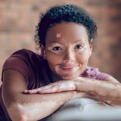What are the types of skin pigmentation